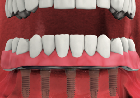 implant-supported-dentures