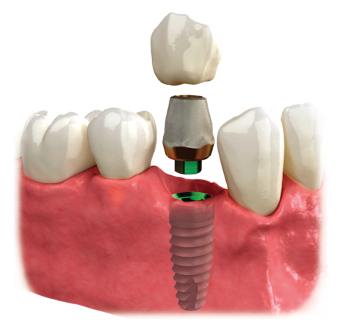 single-dental-implant